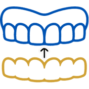 Clear Aligners