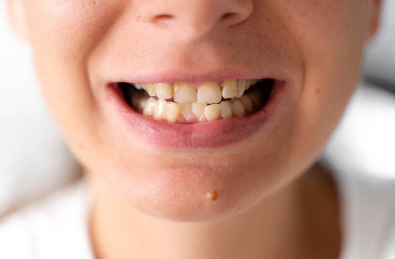 使用牙套、箍牙來改善咬合不正問題，重拾自信笑容