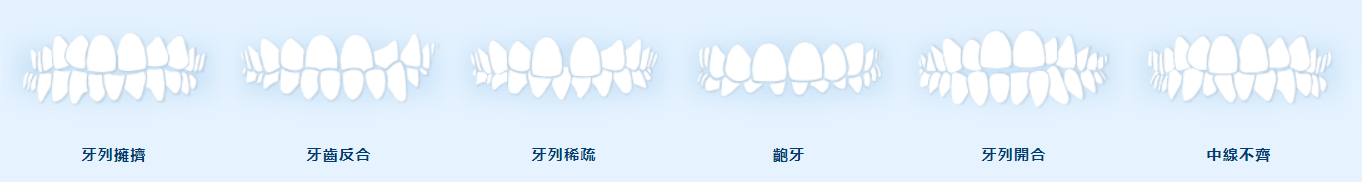 咬合不正的各種類型