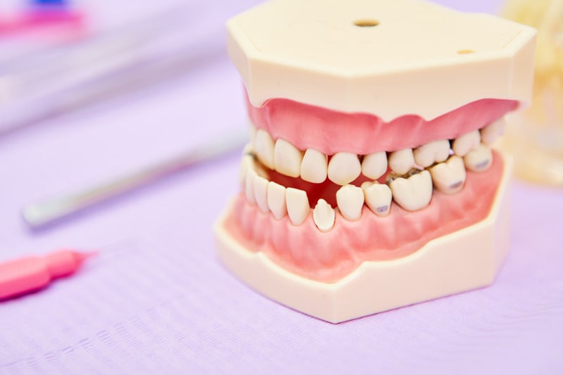 咬合不正指牙齒排列不整齊，不只影響美觀，更可危害健康