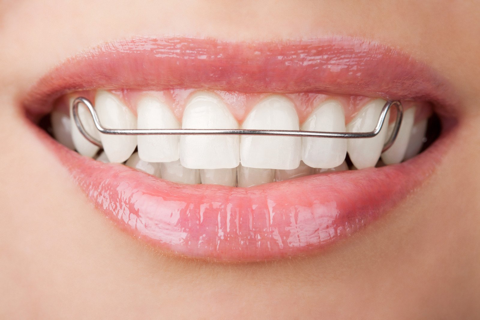 牙醫建議應長時間佩戴固定器
