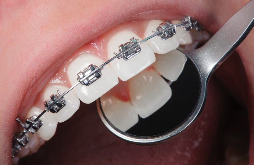 進行定期牙齒檢查，以避免口腔問題