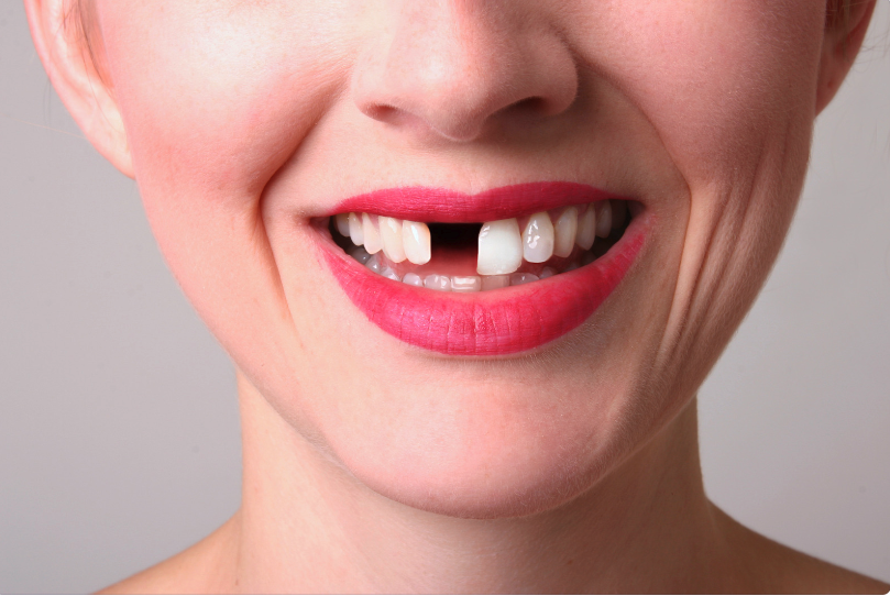 牙齒脫落不補會引致牙齒移位、齒列不整