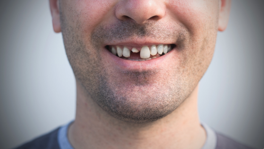 牙齒損傷或缺失亦會導致牙縫過大的問題