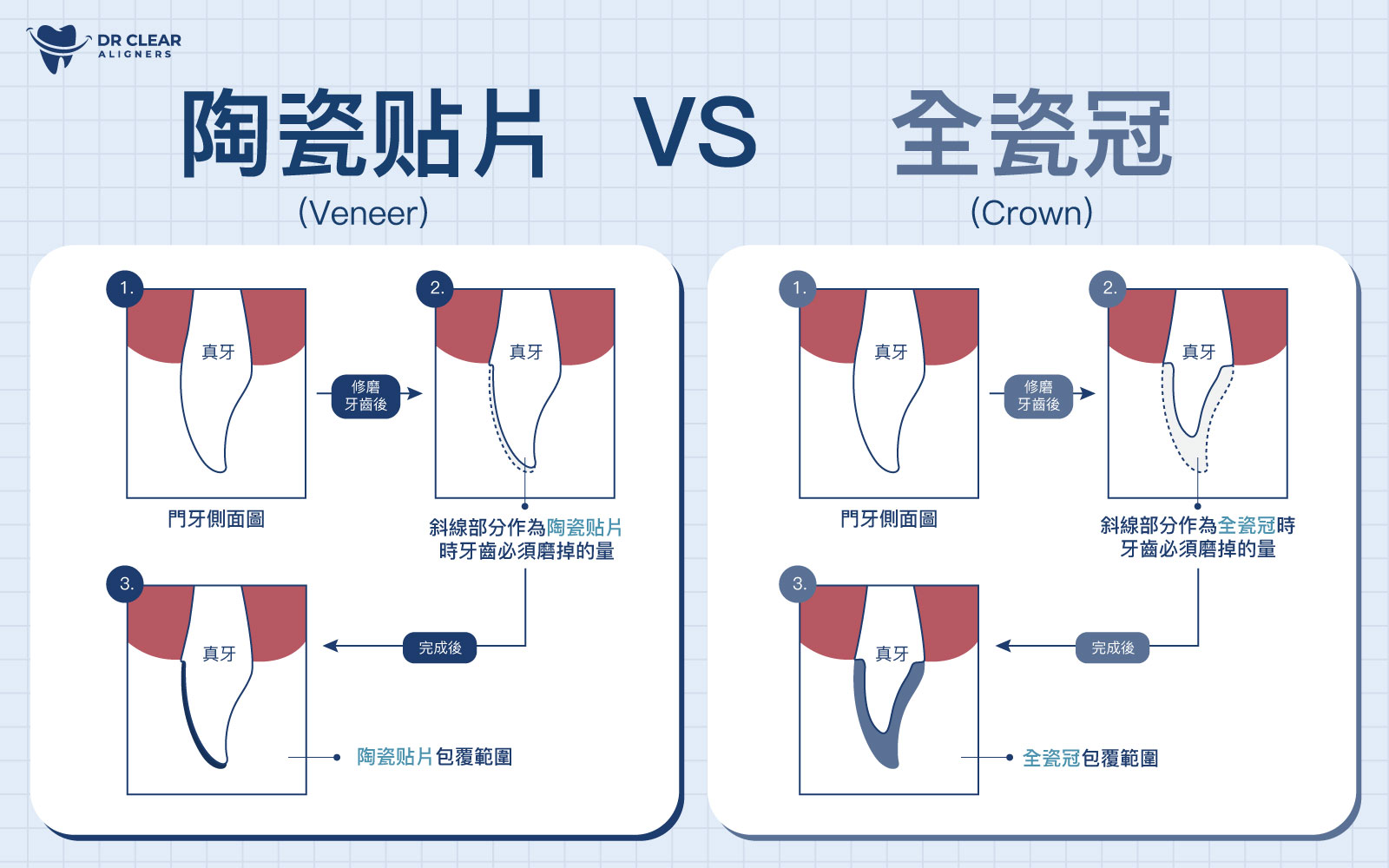 全瓷冠與陶瓷贴片製作流程