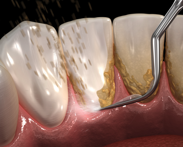 定期進行基礎洗牙可以幫助保持口腔清潔和牙齒健康