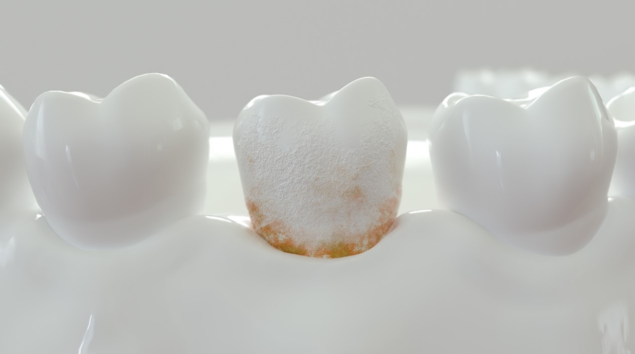 牙結石的成因、形成過程