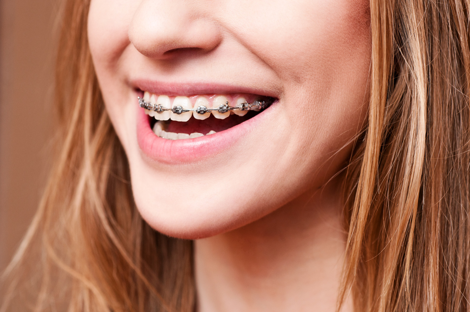 前牙開咬的矯正方法包括傳統牙箍及隱形牙箍矯正