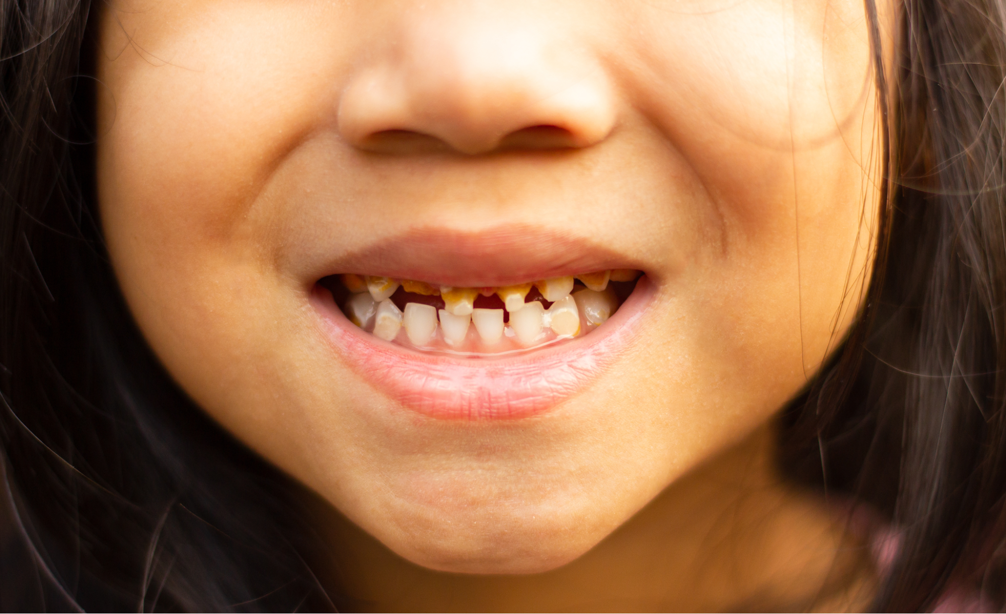 醫學界對於缺牙症成因仍未有確切定論