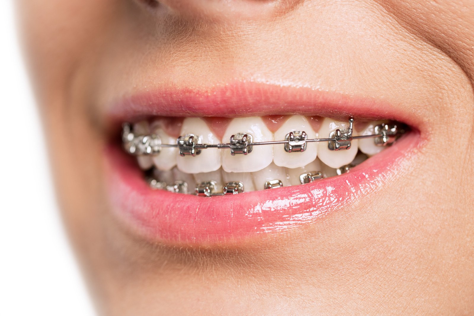 牙齒矯正器是有效改善犬齒突出的問題