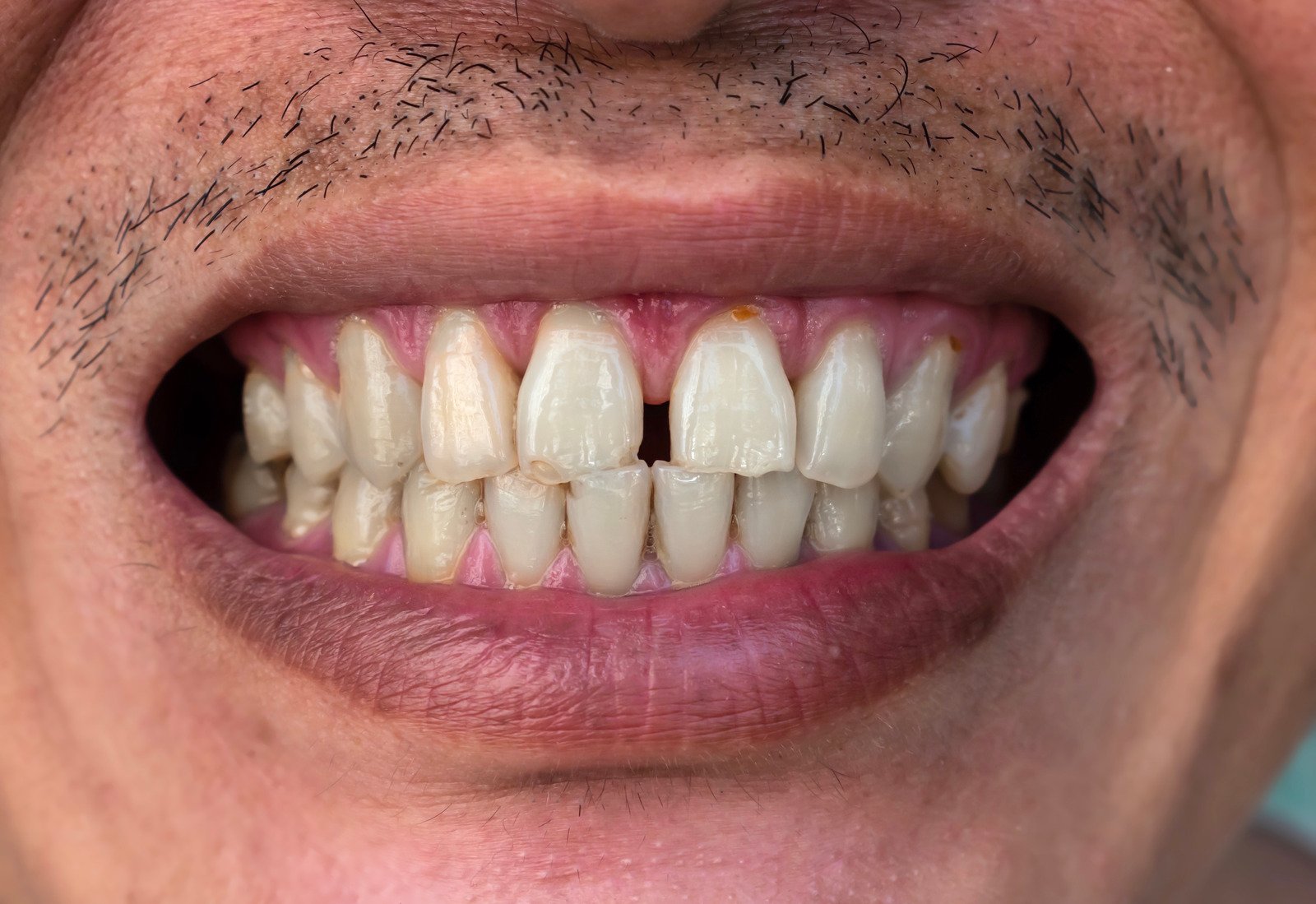 牙醫會透過牙貼或醫學美牙治療黑三角
