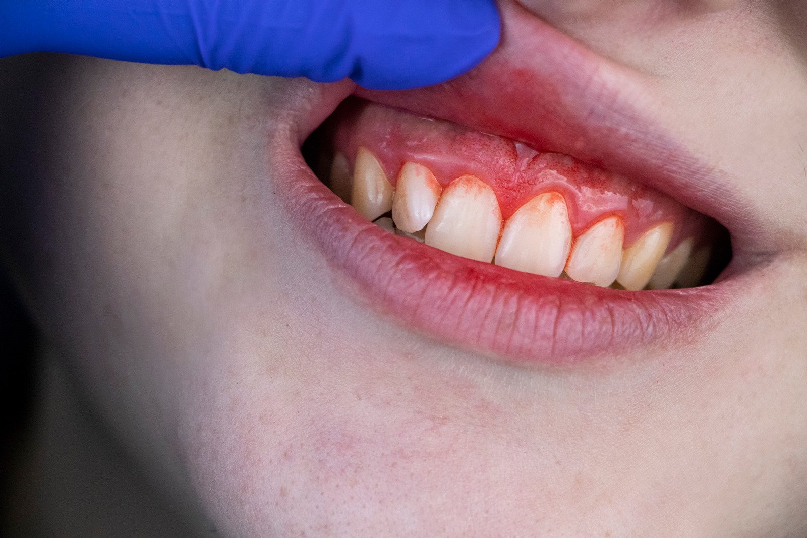 健康的牙齦不會無故地腫脹或流血